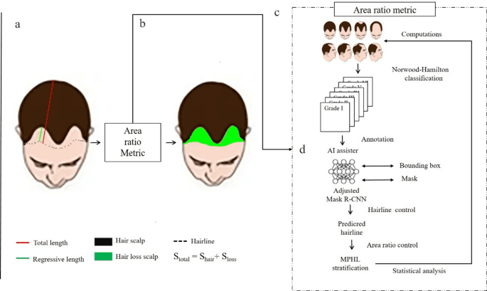 Enhanced stratification of male pattern hair loss using AI through novel loss region ratio analysis